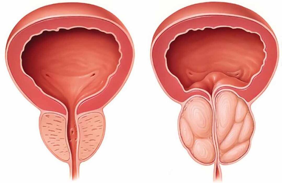 Қалыпты простата және қуық асты безінің қабынуы (созылмалы простатит)