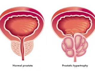 Қалыпты және қабынған простата